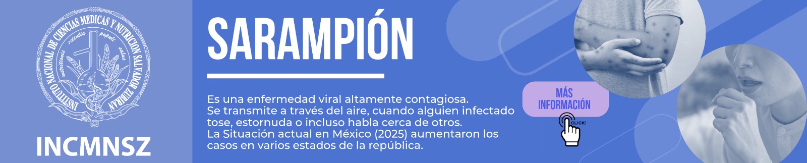 sarampion